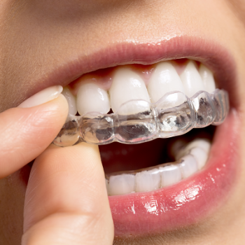 A woman putting on an upper Invisalign aligner